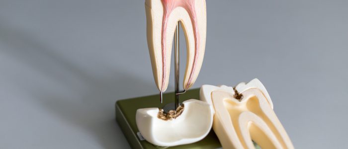 Plastic Model of Tooth Showing Inside and Decay