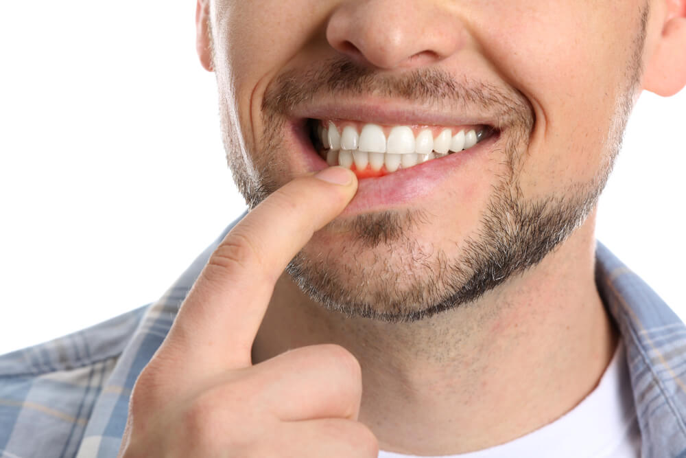 man pulling bottom lip to expose tooth gums