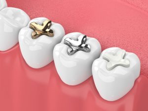 gold, silver, white almagram tooth fillings