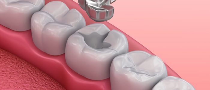 3d model rendering of tooth filling out of a cavity pocket