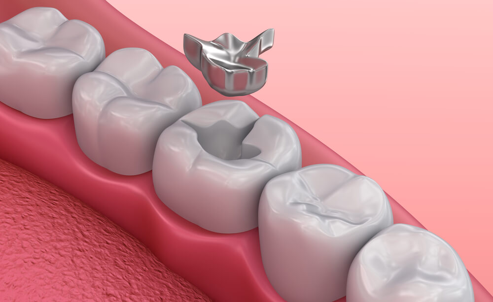 3d model rendering of tooth filling out of a cavity pocket