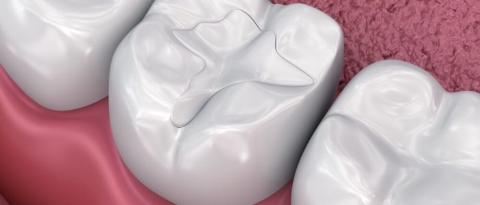 virtual representation of white dental filling on three teeth pink gums
