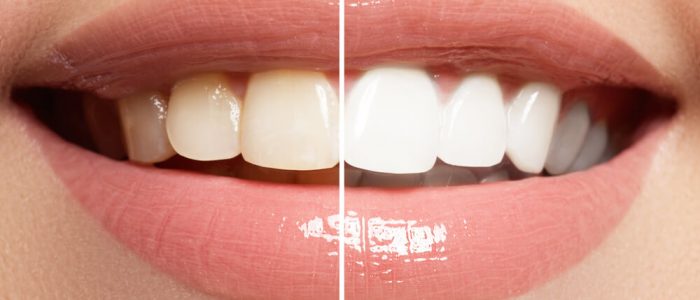 woman's teeth shown before as yellow and after whitening as white