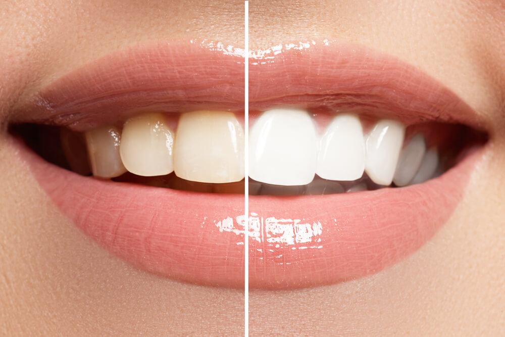 woman's teeth shown before as yellow and after whitening as white