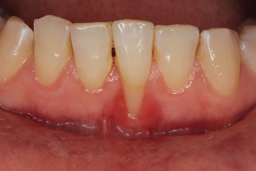 Close up photo, showing a patients recessed gums 
