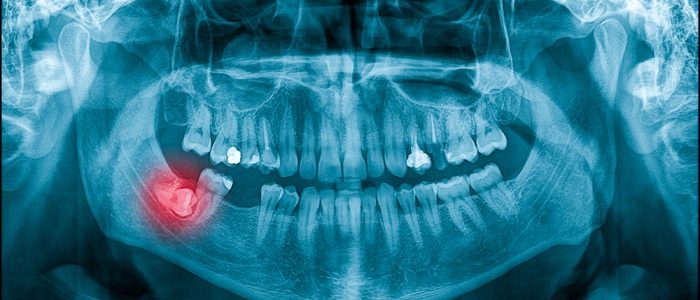 X-ray of a wisdom tooth growing in