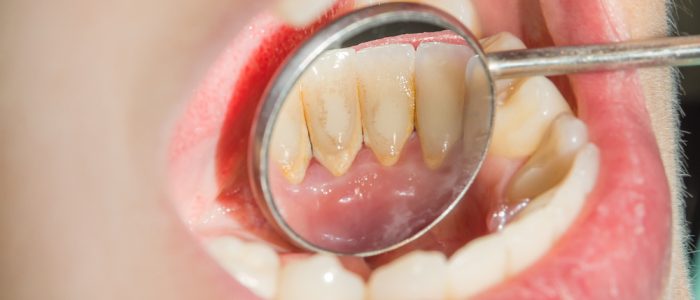 How to get rid of tartar on teeth